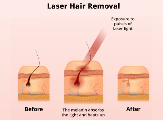 What Happens During the Standard Laser Hair Removal Treatmentin in Hyderabad?